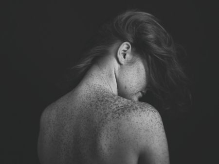 Freckles